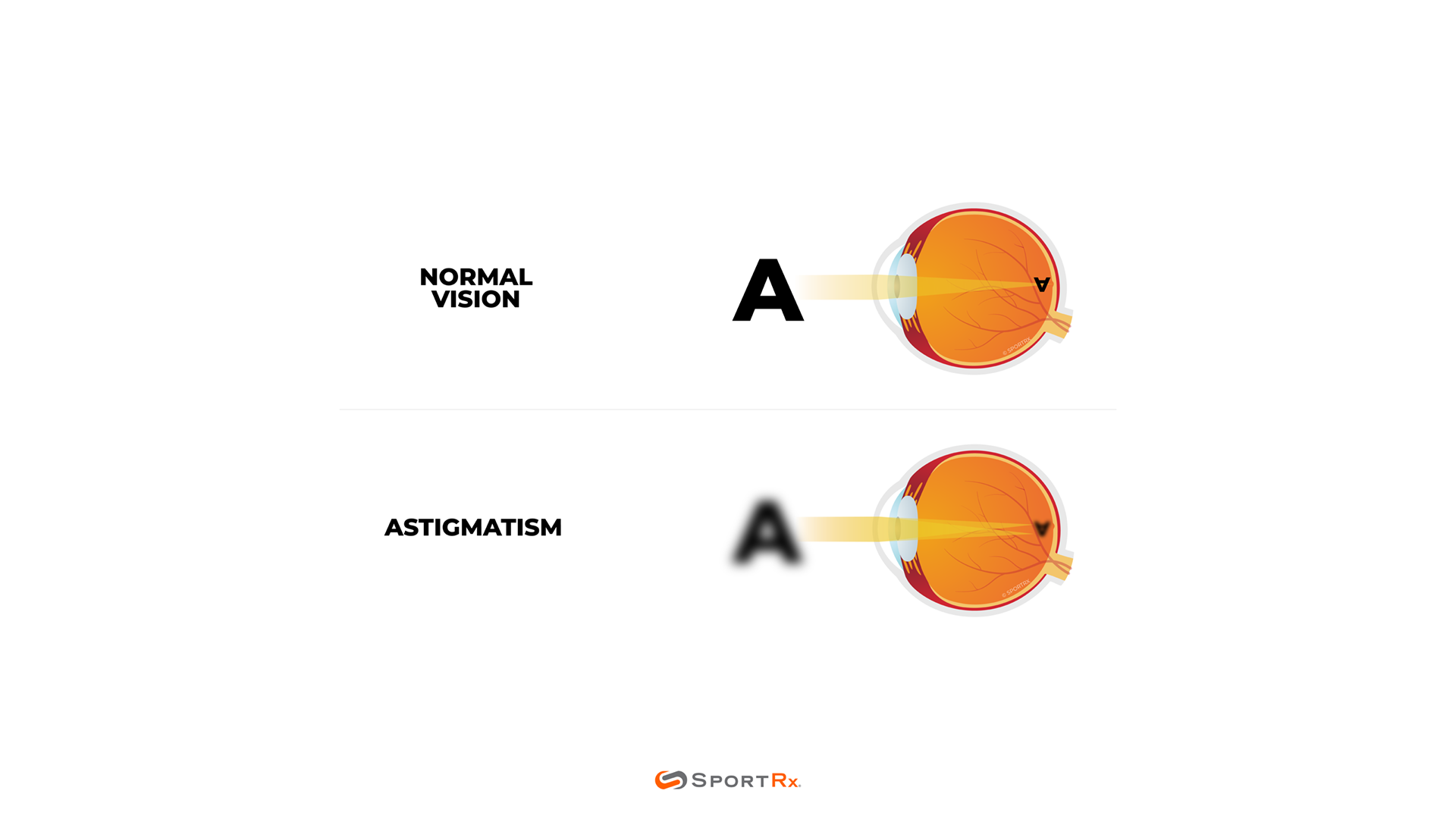 Astigmatism